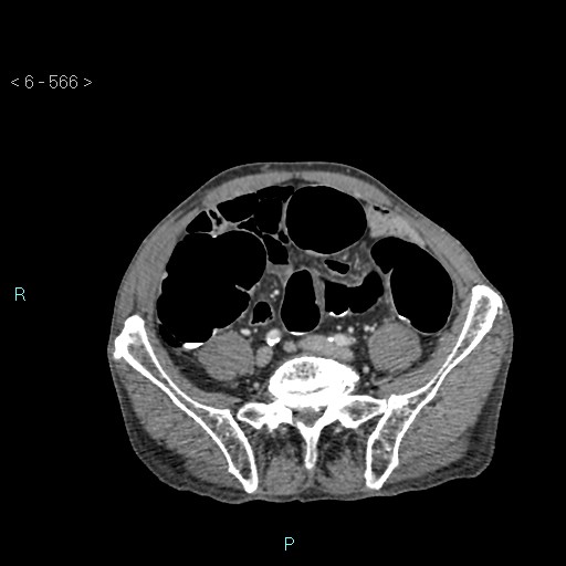 File:Colonic cancer (ultrasound and TC imaging) (Radiopaedia 50346-55713 A 89).jpg