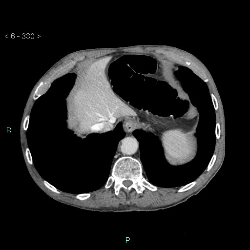 Colonic cancer (ultrasound and TC imaging) (Radiopaedia 50346-55713 B 330).jpg