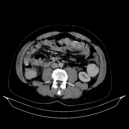 Colonic diverticulosis (Radiopaedia 72222-82744 A 26).jpg