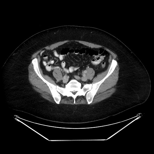 File:Colonic intussusception due to adenocarcinoma (Radiopaedia 86828-102987 A 109).jpg