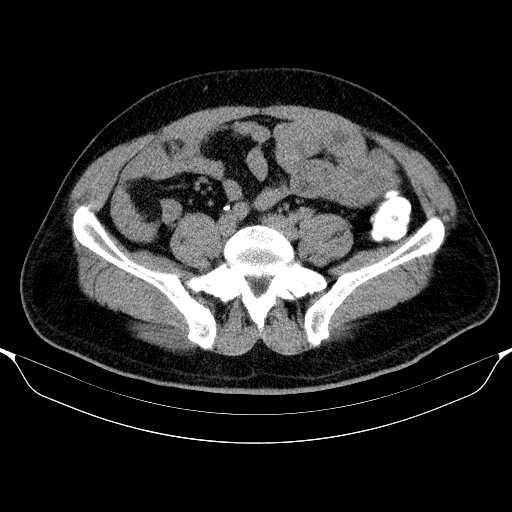 File:Colonic lipoma with colo-colic intussusception (Radiopaedia 58944-66200 Axial 90).jpg
