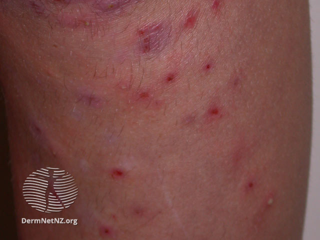 File:Folliculitis due to hair removal (DermNet NZ hair-nails-sweat-removal-foll3).jpg