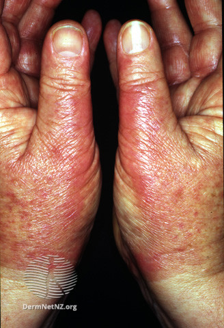 File:Hands burning after PUVA soaks (DermNet NZ procedures-top-puva-burn-hand).jpg
