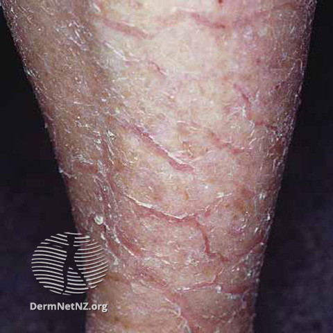 File:Kava ichthyosis (DermNet NZ scaly-ichthyosis1).jpg