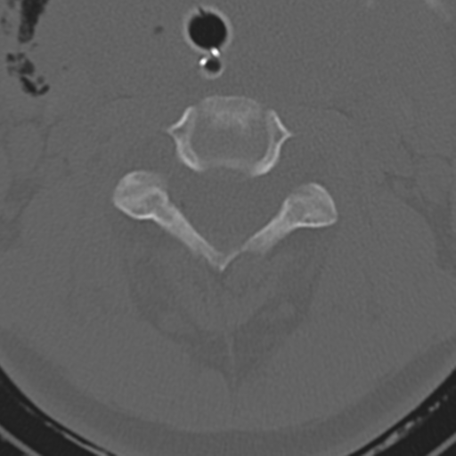File:Multitrauma with diffuse axonal injury, temporal bone fractures and traumatic caroticocavernous fistula (Radiopaedia 37242-39035 Axial 197).png