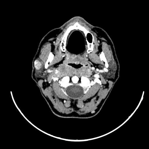 File:Nasopharyngeal carcinoma - infiltrating the clivus (Radiopaedia 62583-70875 Axial Post contrast 24).jpg