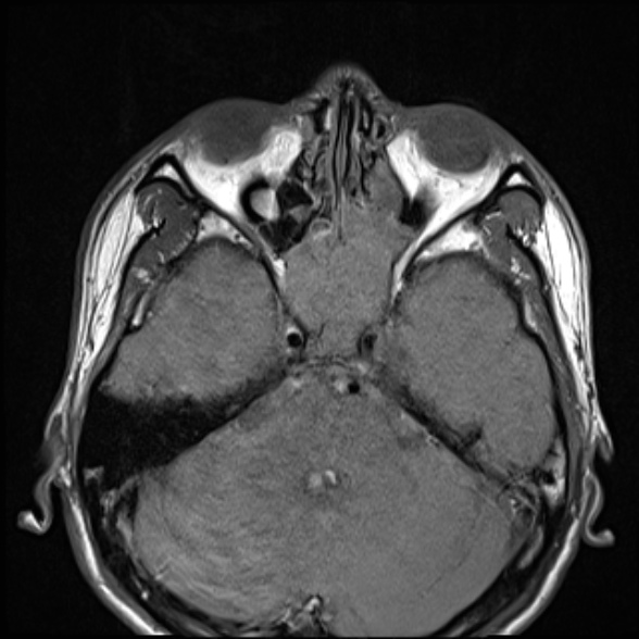 Nasopharyngeal carcinoma with skull base invasion (Radiopaedia 53415-59485 Axial T1 19).jpg