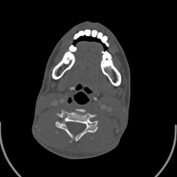 File:Nasopharyngeal carcinoma with skull base invasion (Radiopaedia 53415-59705 Axial bone window 121).jpg