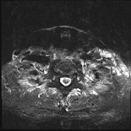 File:Nasopharyngeal carcinoma with skull base invasion (Radiopaedia 59258-66600 Axial T2 fat sat 18).jpg