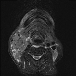 File:Nasopharyngeal carcinoma with skull base invasion (Radiopaedia 59258-66600 D 46).jpg