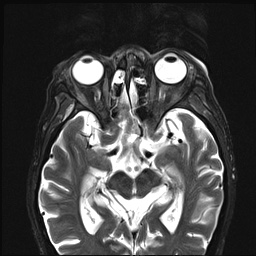 File:Nasopharyngeal carcinoma with skull base invasion (Radiopaedia 59258-66600 D 5).jpg