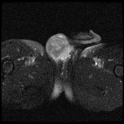 File:Necrotizing epididymo-orchitis with intra-testicular abscess (Radiopaedia 29397-29860 Axial T2 fat sat 12).jpg