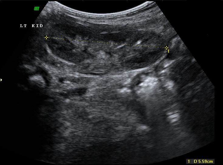 File:Neonatal neuroblastoma (Radiopaedia 9564-10221 A 8).jpg