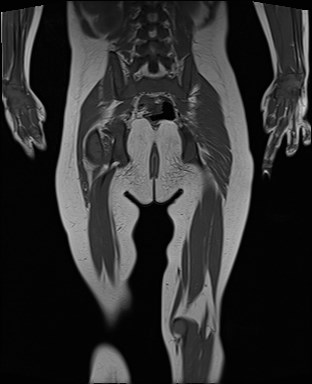 File:Neuroblastoma with bone metastases (Radiopaedia 67080-76414 Coronal T1 19).jpg
