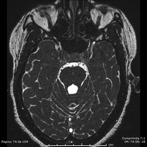 Neurocysticercosis (Radiopaedia 58636-65832 I 76).jpg