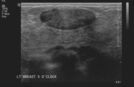 File:Neurofibromatosis of breast (Radiopaedia 5921-7462 J 1).jpg