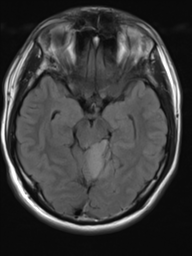 File:Neurofibromatosis type 2 (Radiopaedia 44936-48838 Axial FLAIR 9).png