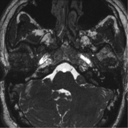 Neurofibromatosis type 2 (Radiopaedia 44936-48838 E 21).png