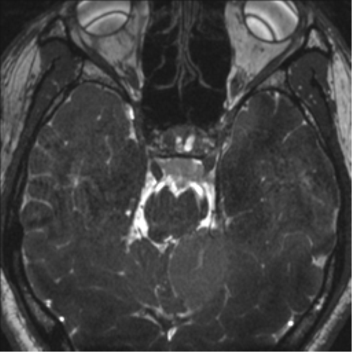 Neurofibromatosis type 2 (Radiopaedia 44936-48838 E 50).png