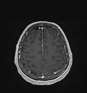 Neurofibromatosis type 2 (Radiopaedia 79097-92049 Axial T1 C+ 155).jpg