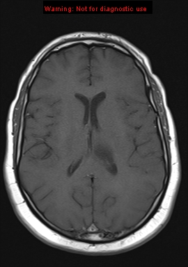 File:Neuroglial cyst (Radiopaedia 10713-11184 Axial T1 10).jpg