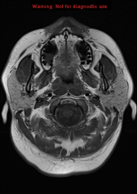 File:Neuroglial cyst (Radiopaedia 10713-11184 Axial T1 22).jpg