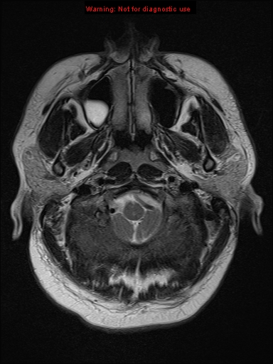 File:Neuroglial cyst (Radiopaedia 10713-11184 Axial T2 21).jpg