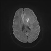 File:Neurotoxoplasmosis - concentric target sign (Radiopaedia 70644-80784 Axial DWI 14).jpg