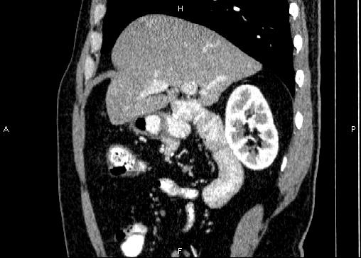 Non-syndromic pancreatic endocrine tumor (Radiopaedia 86958-103178 E 32).jpg