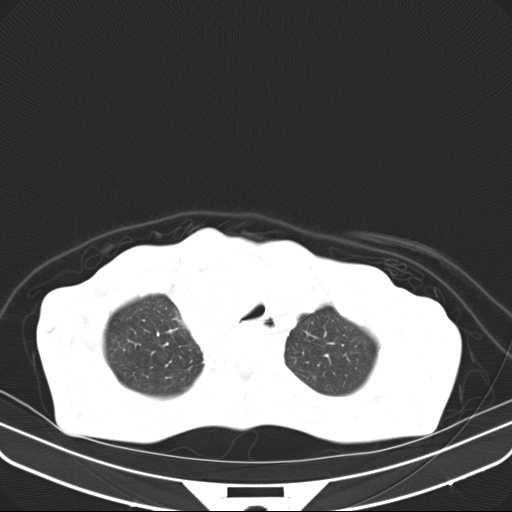 File:Non hodgkin lymphoma of the mediastinum (Radiopaedia 20814-20729 Axial lung window 10).jpg