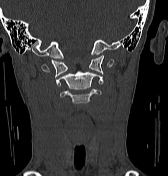 File:Normal CT cervical spine - 12-year-old (Radiopaedia 55352-61775 Coronal bone window 73).jpg