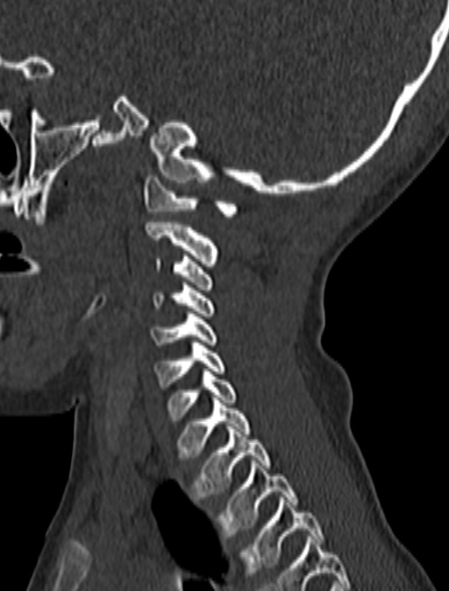 Normal CT cervical spine - pediatric (Radiopaedia 52549-58462 Sagittal bone window 51).jpg