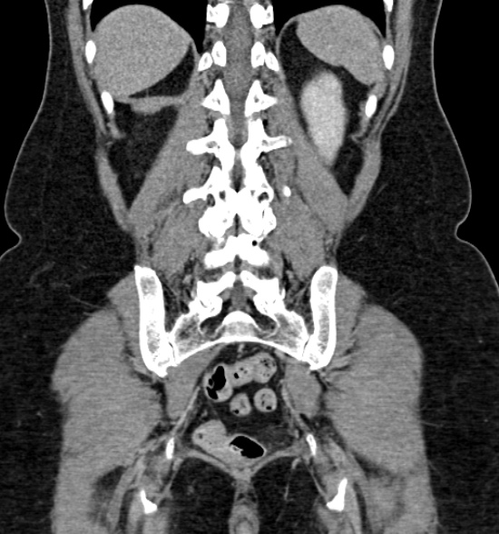 Normal CT intravenous urogram (Radiopaedia 39444-41759 A 342).jpg