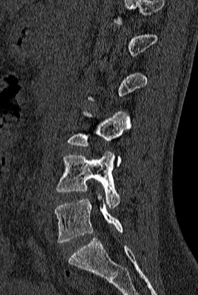 File:Normal CT lumbar spine (Radiopaedia 53981-60118 Sagittal bone window 34).jpg