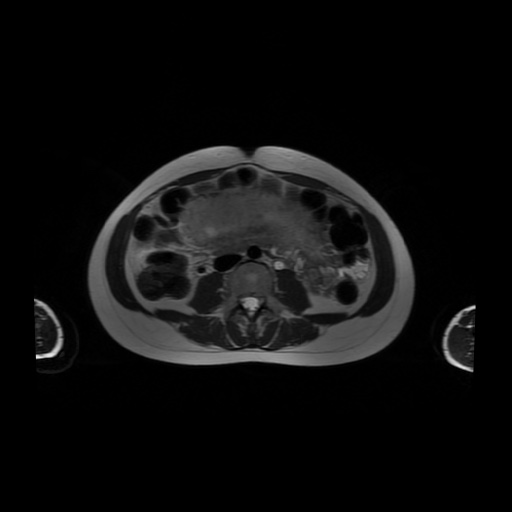 File:Normal MRI abdomen in pregnancy (Radiopaedia 88001-104541 Axial T2 36).jpg