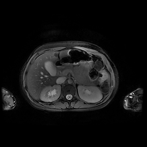 File:Normal MRI abdomen in pregnancy (Radiopaedia 88001-104541 D 16).jpg