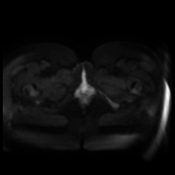 Normal MRI abdomen in pregnancy (Radiopaedia 88005-104548 Axial DWI 38).jpg