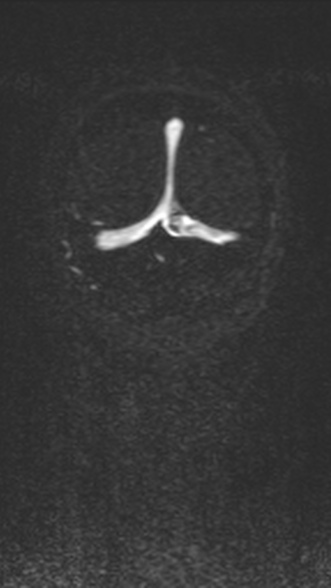 Normal MRI brain with MRV- teenager (Radiopaedia 49425-54553 Coronal MRV 211).jpg