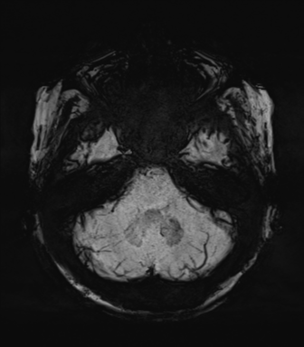 Normal MRI internal auditory canal (Radiopaedia 41613-44525 Axial SWI MIP 18).png