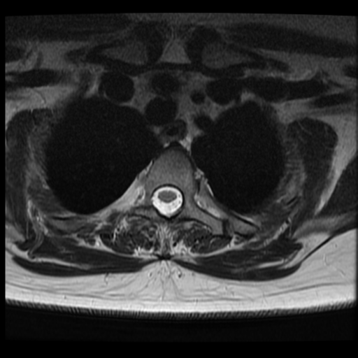 File:Normal cervical and thoracic spine MRI (Radiopaedia 35630-37156 Axial T2 1).png