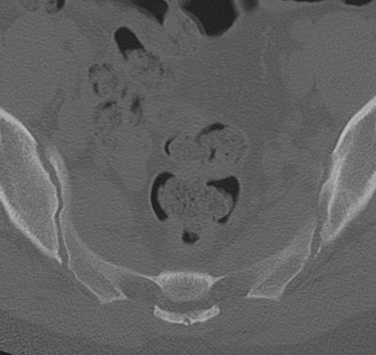 File:Normal lumbar spine CT (Radiopaedia 46533-50986 Axial bone window 81).png
