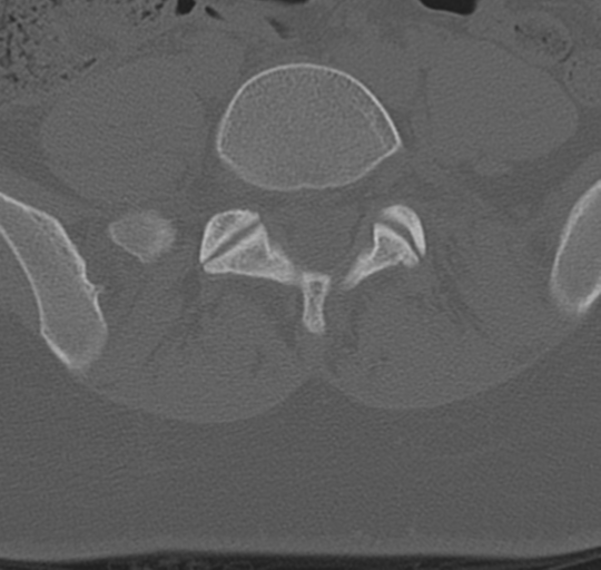 File:Normal lumbosacral CT (Radiopaedia 37923-39867 Axial bone window 76).png