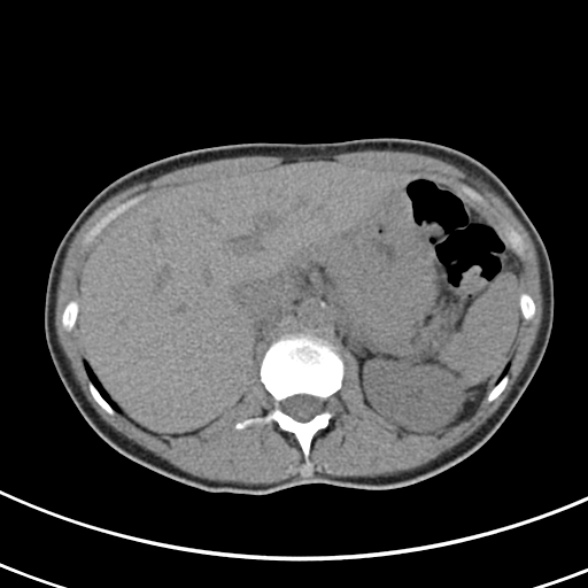 File:Normal multiphase CT liver (Radiopaedia 38026-39996 Axial non-contrast 18).jpg