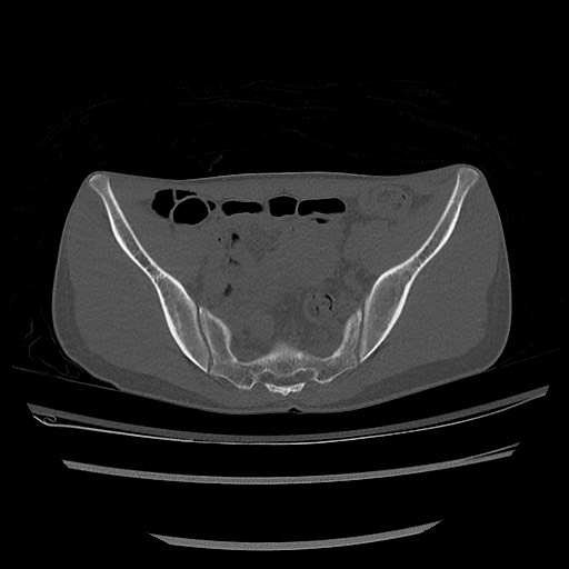Normal pelvis CT (Radiopaedia 51471-57236 Axial bone window 41).jpg