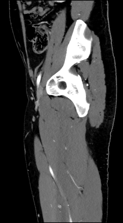 Normal pelvis CT angiogram (Radiopaedia 84966-100481 C 35).jpg