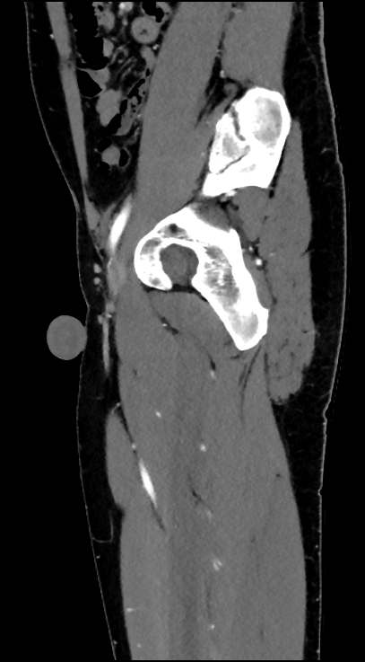 Normal pelvis CT angiogram (Radiopaedia 84966-100481 C 74).jpg