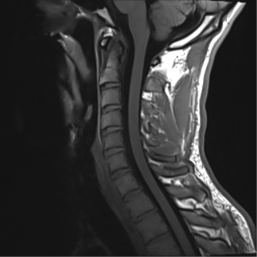 File:Normal trauma cervical spine (Radiopaedia 41017-43762 Sagittal T1 8).png