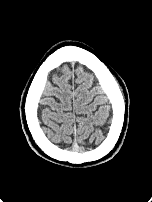 Normal trauma protocol brain and C-spine CT (Radiopaedia 83302-97709 Axial non-contrast 17).jpg