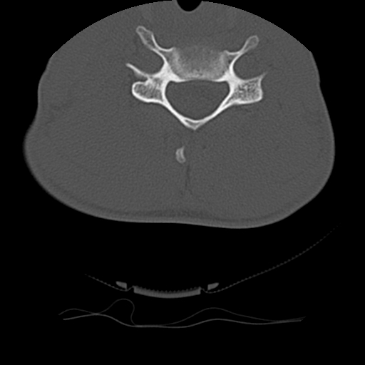 File:Normal trauma spine imaging (age 16) (Radiopaedia 45335-49358 Axial bone window 52).jpg