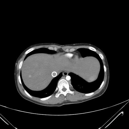 File:Nutmeg liver- Budd-Chiari syndrome (Radiopaedia 46234-50635 A 9).png